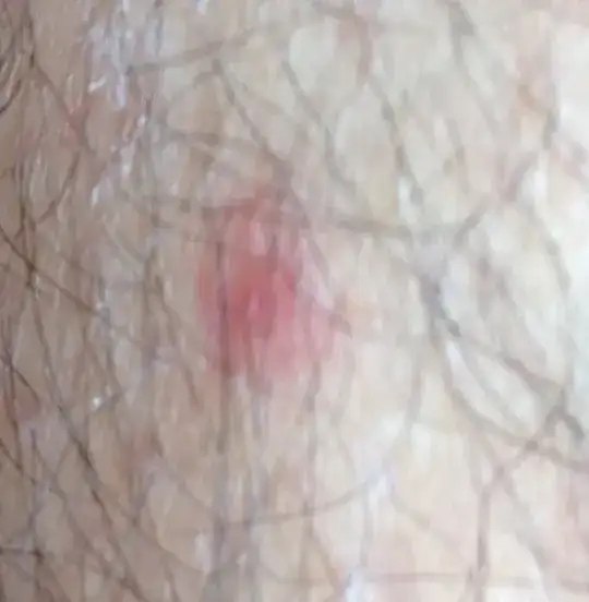 Flea bites on leg after 3 days